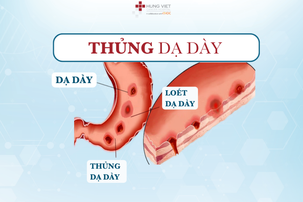 THỦNG DẠ DÀY