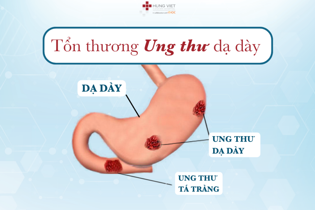 UNG THƯ DẠ DÀY