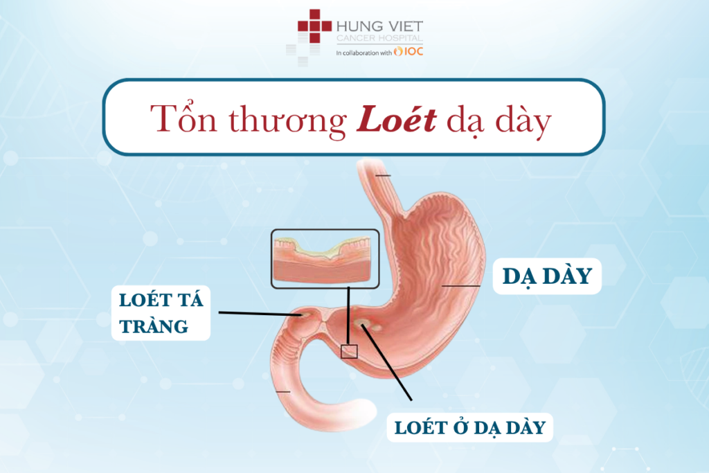 LOÉT DẠ DÀY