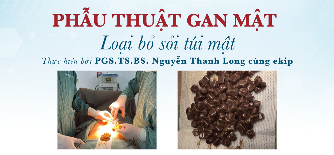Loại bỏ toàn bộ 104 viên sỏi trong túi mật — tránh nguy cơ viêm nhiễm và tắc mật