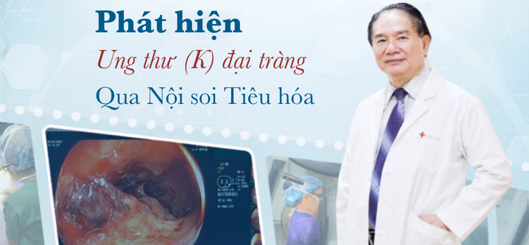 Ung thư đại tràng Sigma được phát hiện qua nội soi