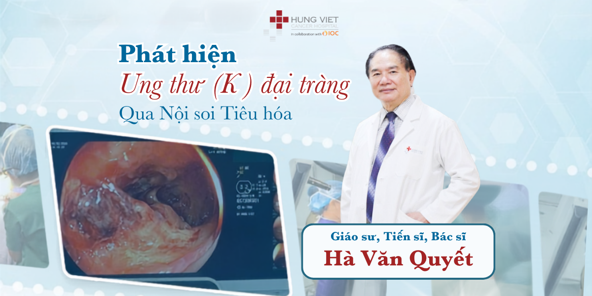 Ung thư đại tràng Sigma được phát hiện qua nội soi