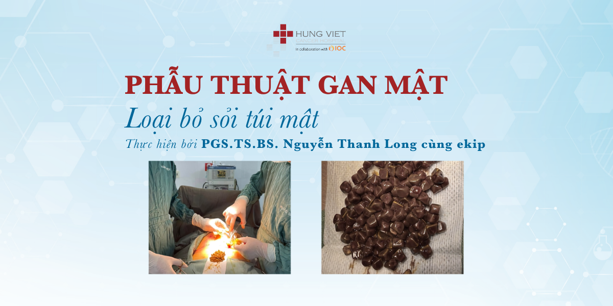 Loại bỏ toàn bộ 104 viên sỏi trong túi mật — tránh nguy cơ viêm nhiễm và tắc mật
