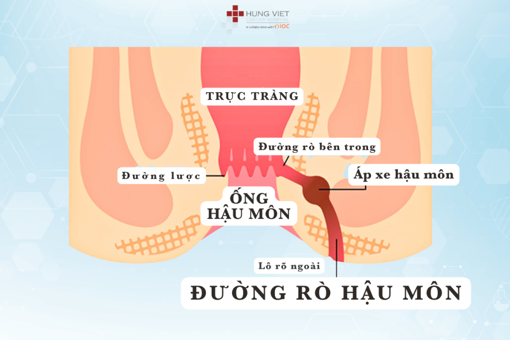 rò hậu môn và áp xe hậu môn xuất hiện đồng thời